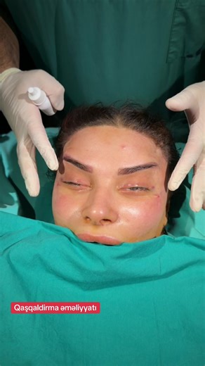 #drelvin #rinoplastika #bakuazerbaijan #emeliyyat #kesfet
