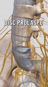 32K views · 895 reactions | A disc prolapse occurs when the inner...