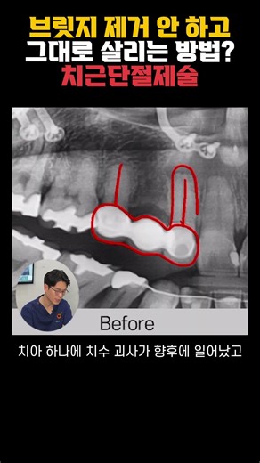 브릿지도 살리고 치아도 살리는 미세현미경 치근단절제술 👍