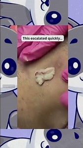 🔥Deep Blackheads, Milia & Whitehead Removal pimple popping New| Big Cystic Acne Extraction