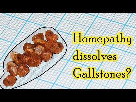Can homeopathic medicine dissolve gallstones? - Dr. Sanjay Panicker