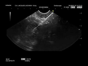 EUS-guided gastroenterostomy with the Hot-Axios LAMS