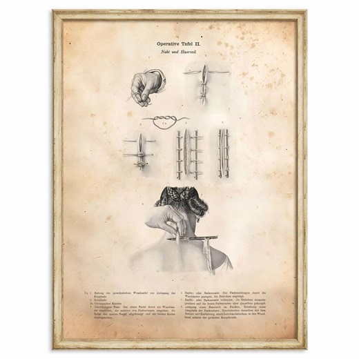 Surgical Suture Techniques 1865 Print, European Medical Illustration, German Operative Plate, Vintage Science Art Clinic Office Study Room - Etsy