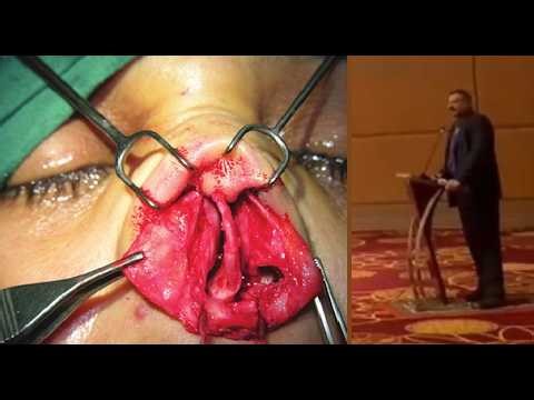 Rhinoplasty & Septoplasty