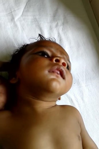 Suprasternal recession infant with laryngomalacia