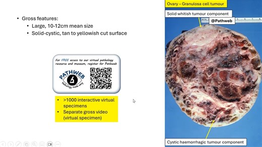 Ovary: Granulosa cell tumour, adult type - Virtual microscopy