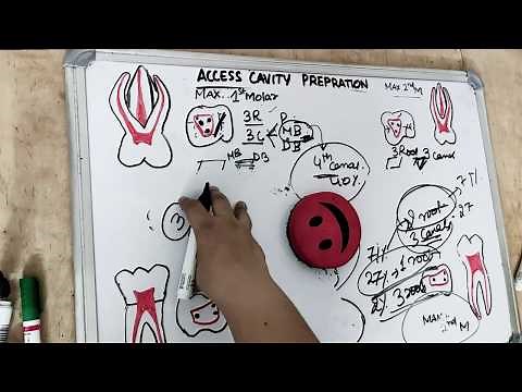 access cavity preparation - premolar & molar