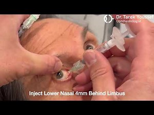 Bilateral intravitreal injections by Dr. Youssef