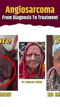 Angiosarcoma Cancer | Biopsy Side Effects | Rare Cancer | 4th Stage Cancer Survivor | Hiims Hospital