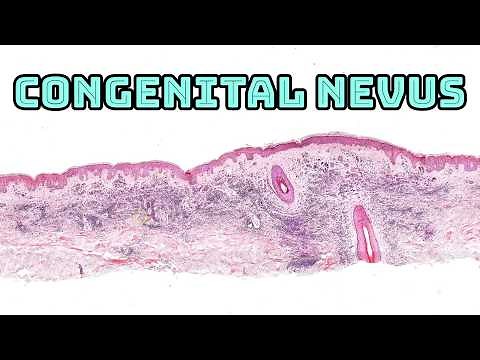 Congenital nevus under microscope (perineural growth & type B melanocytes mimicking lymphocytes)