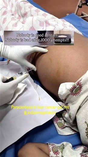 paracentesis step by step | Ascitic tapping procedure | Indian respiratory Therapist