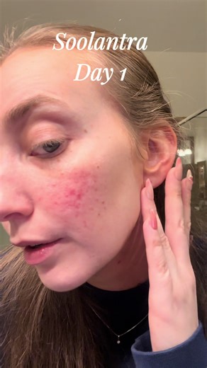 lets see how this goes #rosacea #soolantra #skincareroutine | Skincare