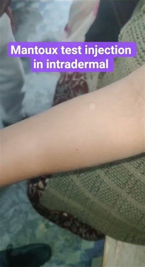 🏥⚕️intradermal injection💉 mantoux test #doctor #medical #hospital #nursing