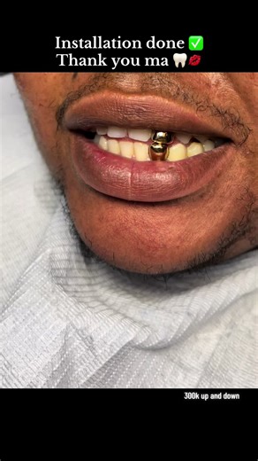 How Much Do Gold Teeth Cost? Installation Guide