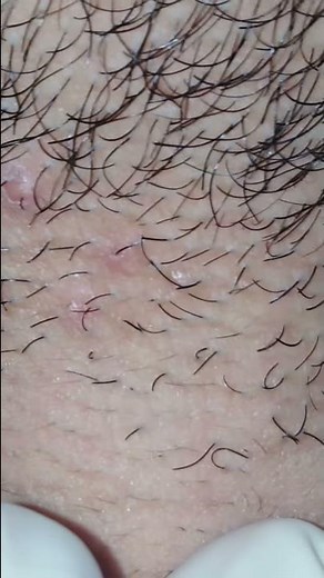 Ingrown Hair Removal From the neck.