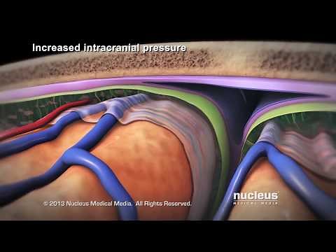Craniotomy and Craniectomy at Cook Children's