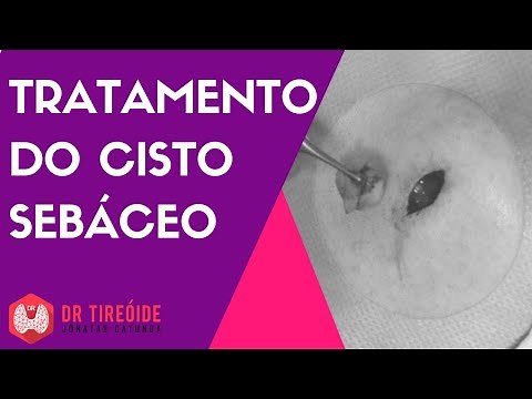 Sebaceous cyst treatment - Dr Jônatas Catunda
