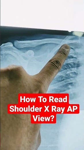How To Read Shoulder X Ray AP View? Dr Sai Chandra MBBS DNB Ortho