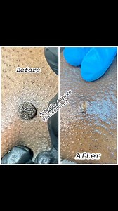 Before and after laser surgical wart procedure Awwwwwwwwww satisfied clientFull pictures on WhatsApp 💃💃💃💃💃💃Odogwu skin doctor 👩‍⚕️ Jumella Empire you do this one💃💃💃💃Rate this job💃💃💃💃💃💃Satisfied client Self confidence restored 08126000002#fynシ゚viralシ #viralreels #lasercut #WartRemoval #fynシ゚viralシ #viralreels #WartRemoval #foryoupage #face | Stella Jumbo