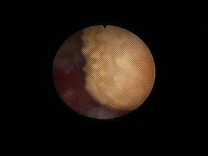 Ureteroscopy and laser lithotripsy of kidney stones