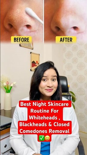 Best Night Skincare Routine For Whiteheads, Blackheads & Closed Comedones Removal | #doctorrajni