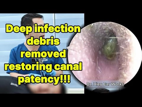 Deep infection debris removed restoring canal pate | ear cleaning | ASMR earwax | soothing |relax|