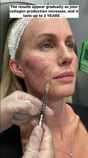 The Sculptra Collagen Stimulater Results at Dr. Medispa