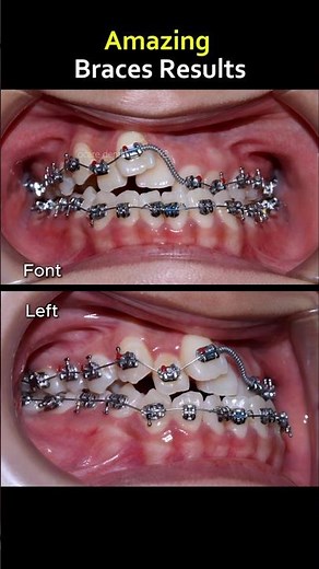 Power of braces. Fix super crooked teeth easy #braces #dentist #orthodontist #teeth