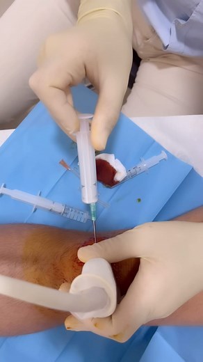 Bursitis infrapatelar superficial: evacuación ecoguiada Superficial infrapatellar bursitis: Ultrasound- guided interventional procedure | Doctor Lara Trauma Sevilla y Huelva