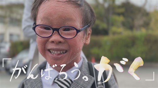 【長編】ピエロと呼ばれた息子～取材5年　皮膚の難病・道化師様魚鱗癬～2025年3月30日地上波放送