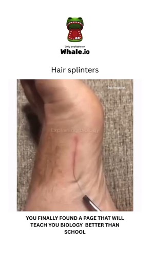 BIOLOGY | MEDICAL | HEALTH on Instagram: "Hair splinters are fine strands of hair that pierce and become embedded in the skin, causing pain and irritation similar to a regular splinter. They are commonly caused by freshly cut hair, especially coarse or thick hair, or by loose hair trapped in clothing or bedding that rubs against the skin. While they are usually harmless, they can lead to infection, so it’s best to remove them with tweezers or by using a sticky method like tape. Dm for credit or