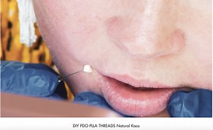 PDO, PLLA and PCL FACIAL THREADS - Natural Kaos