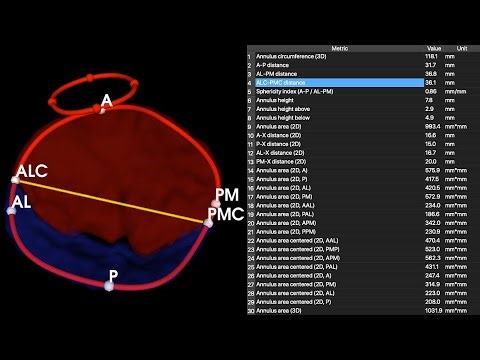 SlicerHeart: Valve Quantification in 3D Slicer