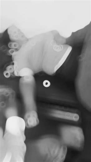 Medical Procedure Insights: Blood Drawing Explained