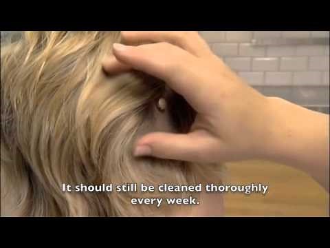 Baha - Keeping the Abutment Clean