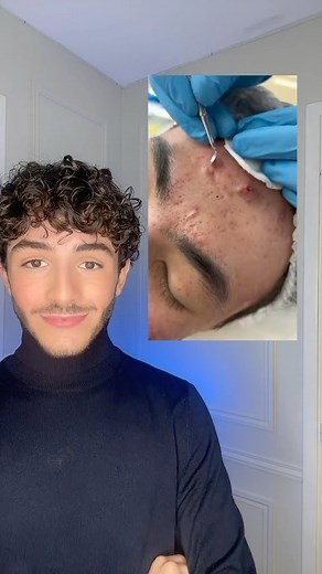 Samy 🧪 | ✅ 10/10 pour cette extraction de comédons parfaitement réalisée ! 🔬 Pour ce genre d’acné je te recommande d’utiliser des rétinoïdes ou du... | Instagram