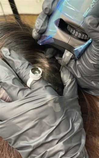 SCATTER Scalp Micro-Dot Technique | Female Crown Area Procedure (Process Demo)