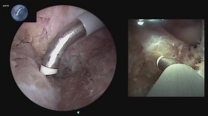 PCL Reconstruction Using Dual-View Imaging With the Synergy Vision™ System