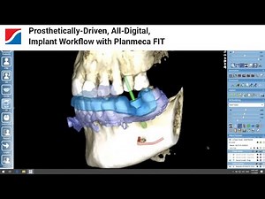 Prosthetically-Driven, All-Digital, Implant Workflow with Planmeca FIT