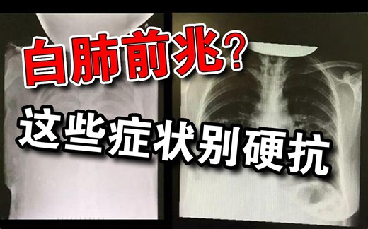 白肺前兆是什么？死亡率40%是真的吗？这些症状别硬扛！怎么预警呢？跟新冠是啥关系啊？