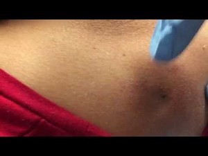 PIMPLE POPPING ON BACK PART2