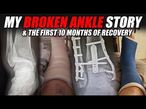 My Broken Ankle Story (Trimaleollar Fracture)