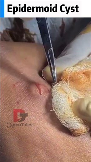 Epidermoid Cyst Removal Surgery | Skin Cyst Removal
