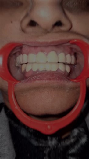 Dr. Aditya Raj on Instagram: "* Single sitting RCT w.r.t 16,13,12,11,21,22,23,24,25,33,32,41, 42, 43 * Extraction done w.r.t 31 ( Grade II Mobility) 27 ( Root stumps ) * T- LITE (PFM) CROWNS w.r.t 16,15,14,13,12,11,21,22,23,24,25,26 (cantilever ) 33,32,31,41,42,43 * Planning implant/ flexible Rpd w.r.t 35,36 and 45,46#dental #rct #extraction #followｍe #crown #esthetics #smile #health #aura #ɪɢʀᴇᴀᴄʜ #beauty #explore #feed"