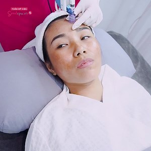  BIẾN HÌNH 360 ĐỘ SAU 4 BUỔI CẤY COLLAGEN TƯƠI CC WHITE  Trực tiếp...