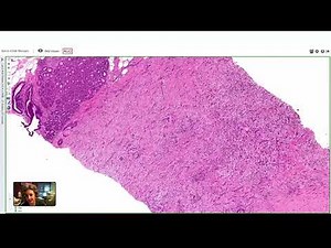 Breast Spindle Cell Lesions by Ashley Cimino-Mathews, M.D.