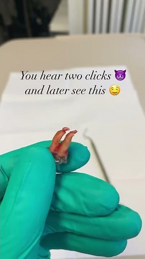 Dental Extraction with broken roots intact. #molar #exodontia