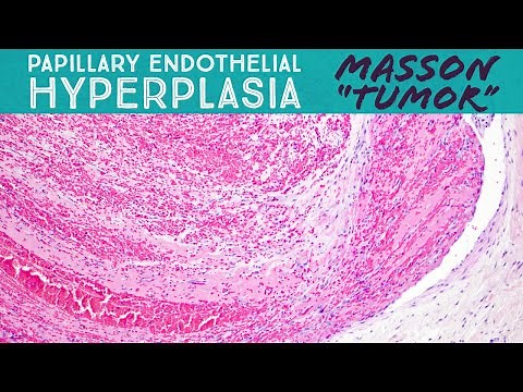 Masson "Tumor" (organizing thrombus & papillary endothelial hyperplasia in a vascular malformation)