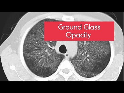 Ground Glass Opacity (GGO) IN HRCT LUNG! #hrct #ground #glass #opacity #radiology #case #ctscan