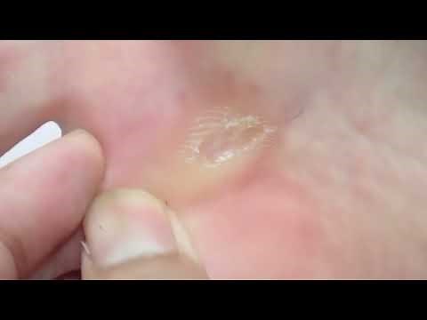 生検トレパンによる鶏眼処置